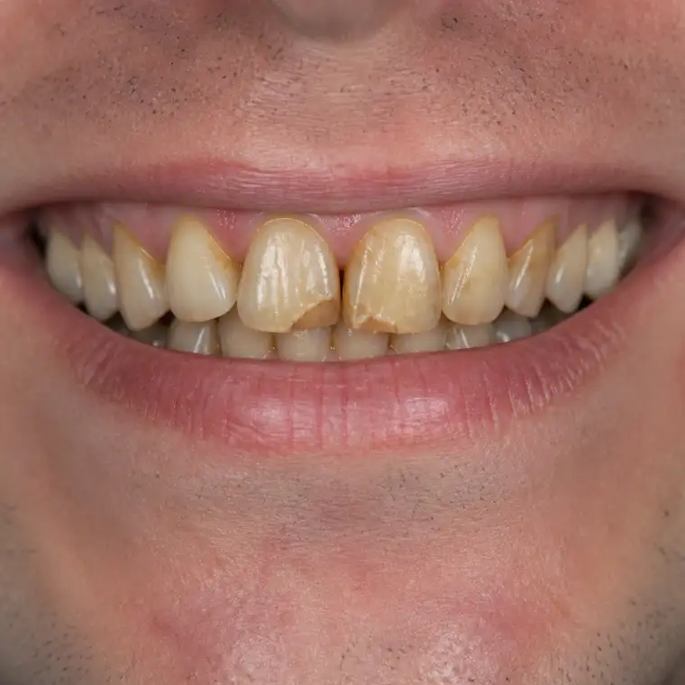 Smile before professional whitening treatment
